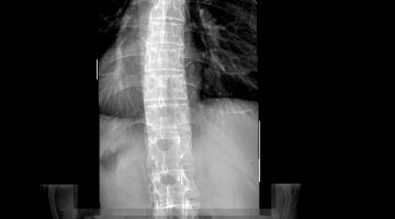 Full spine spinal x-rays