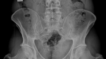 Gonstead pelvis xray