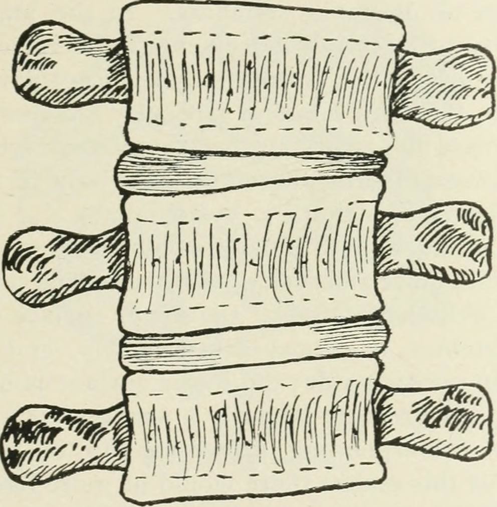 Spinal discs, back pain, disc herniation, and disc bulges.