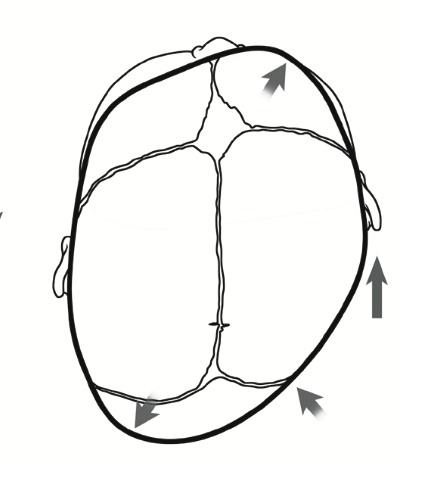 What does Plagiocephaly look like?