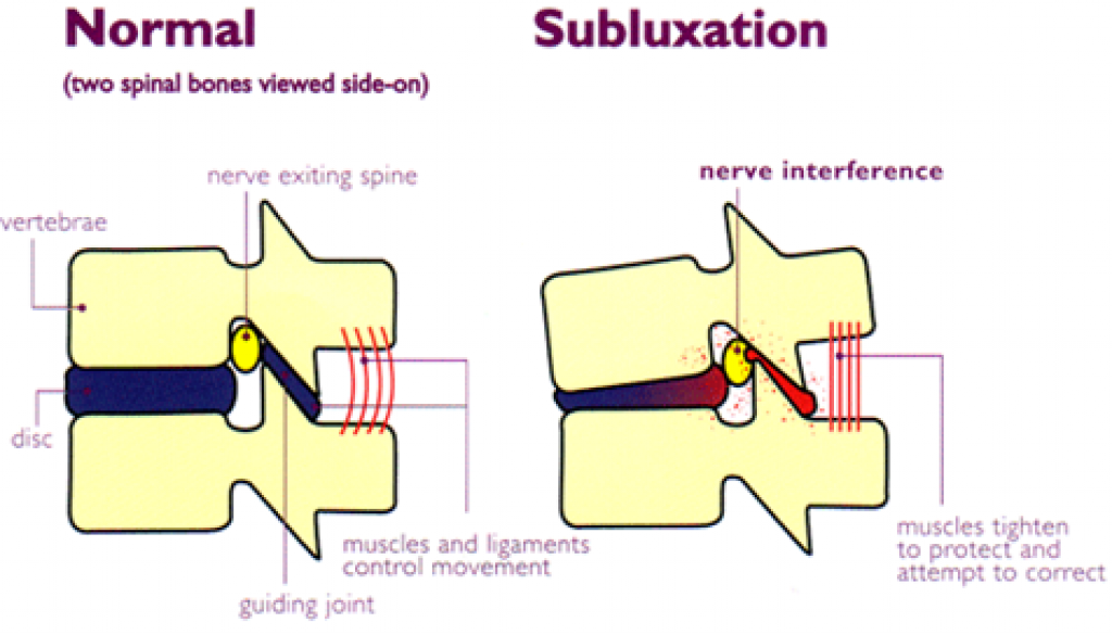 subluxation