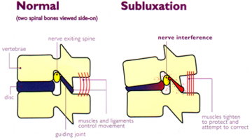 subluxation