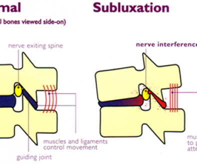 subluxation