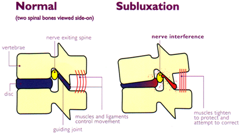 Subluxation: An interference to the nerve system