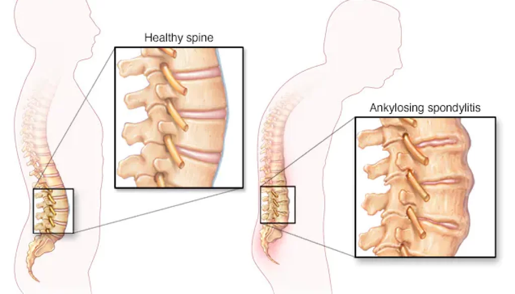 Ankylosing spondylitis_blog