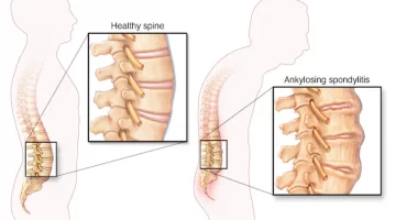 Ankylosing spondylitis_blog