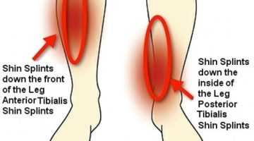 shin-splints-image for blog