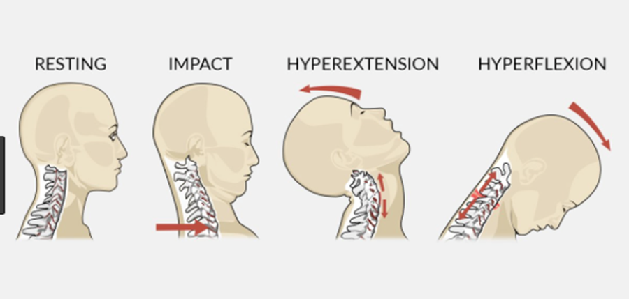 Whiplash, car accidents, and neck pain.