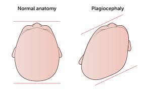 Understanding Plagiocephaly (flat head syndrome)