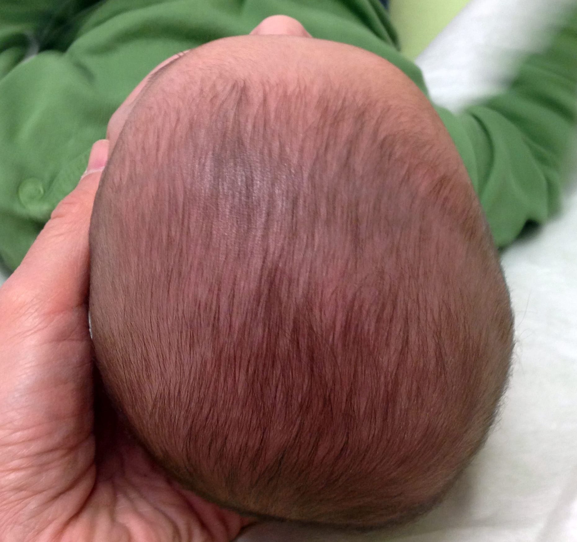 Understanding Plagiocephaly (flat head syndrome): Initial Baby Assessment Steps